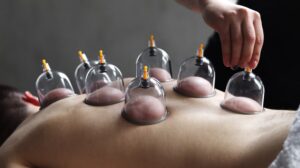 Read more about the article Why is Cupping Therapy Blood Thick